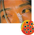 Две трети умерших от гепатита Е в 2005 году составили жители Южной и Восточной Азии